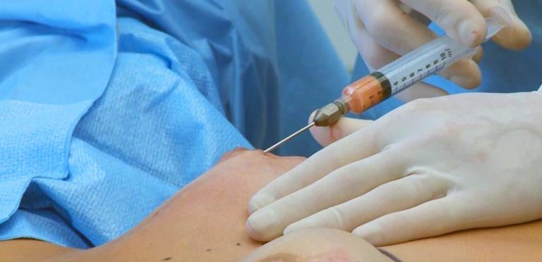 Enxerto de Gordura Feminina | Dr. Cláudio Lemos