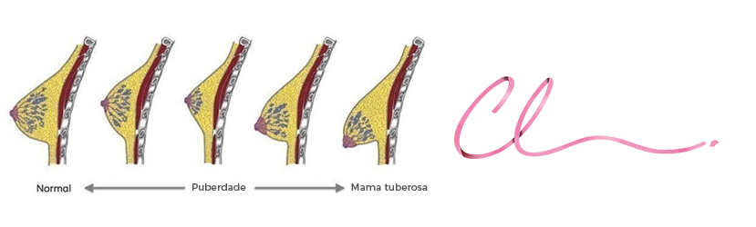 Ilustração das Alterações Anatômicas Durante o Envelhecimento da Mulher Com uma Mama Tuberosa