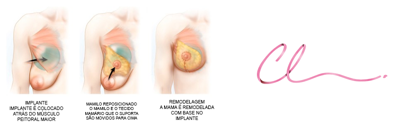 Ilustração da Localização do Implante Mamário na Cirurgia de Mastopexia com Prótese