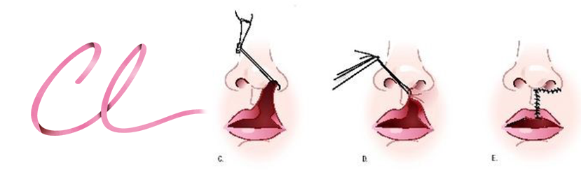 Ilustração da Cirurgia de Lábio Leporino