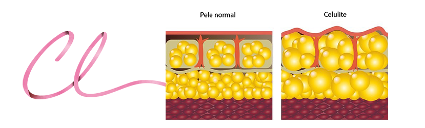 Ilustração Demonstrando a Pele Normal (a esquerda) e o Aspecto de Pele com Celulite (a direita)