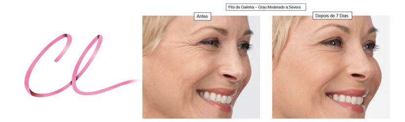 Ilustração da Atenuação dos Pés de Galinha Após a Aplicação de Botox
