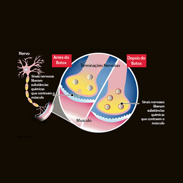Ilustração Demonstrando o Mecanismo de Ação da Toxina Botulínica