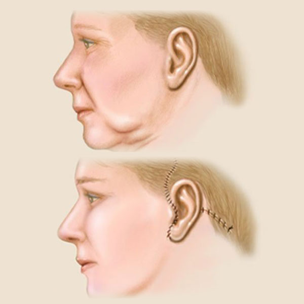Cirurgia Plástica no Rosto – Lifting Facial (Ritidoplastia)