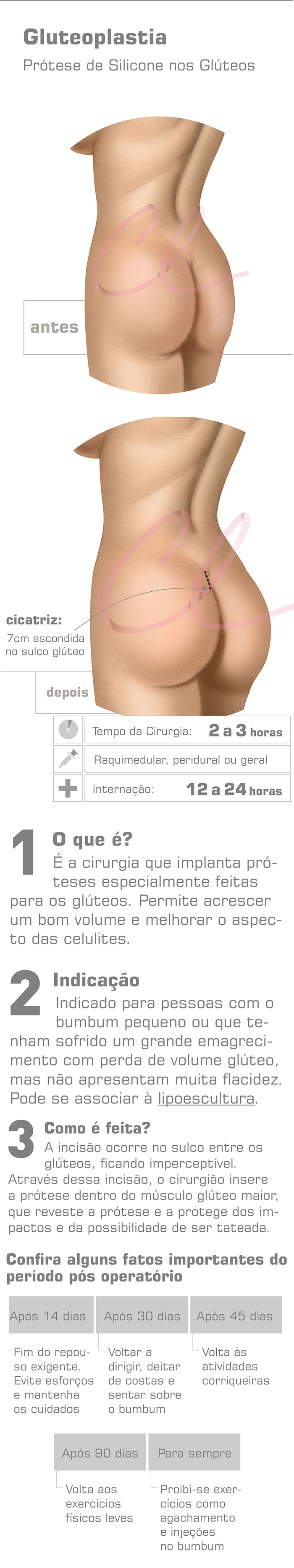 Cirurgia Plástica no Bumbum - Prótese de Glúteo 