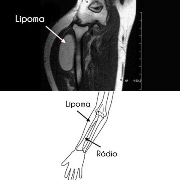 Exame de Imagem de Lipoma