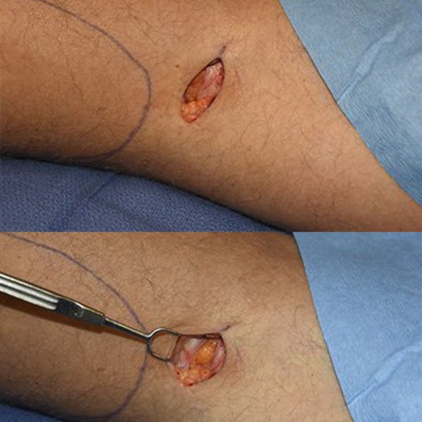 Cirurgia de Prótese de Silicone na Panturrilha