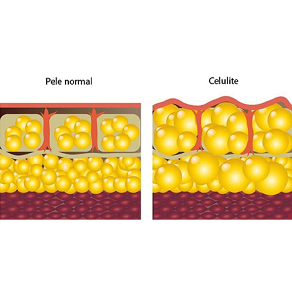 Ilustração Demonstrando a Pele Normal (a esquerda) e o Aspecto de Pele com Celulite (a direita)