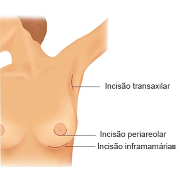 Ilustração Demostrando os Diversos Tipos de Instição Cirúrgica na Cirurgia de Prótese de Mama