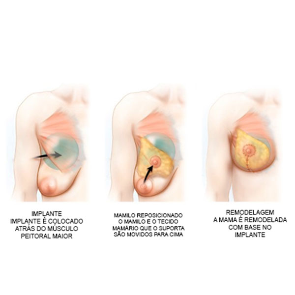 Ilustração da Localização do Implante Mamário na Cirurgia de Mastopexia com Prótese