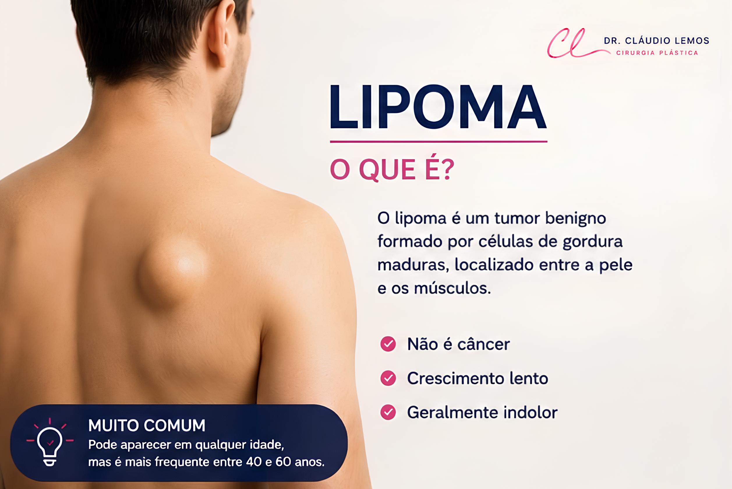 Ilustação de um homem com limpoma
