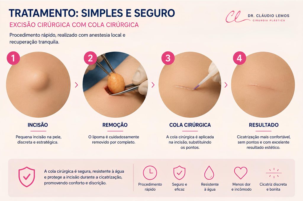 Ilustração demostrando o tratamento cirurgico do Lipoma.