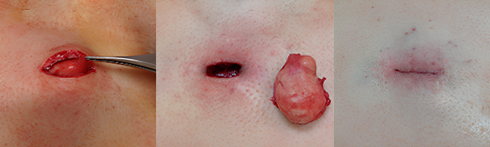 Cirurgia de um Cisto Sebáceo com a Finalização com a Cola Cirúrgica