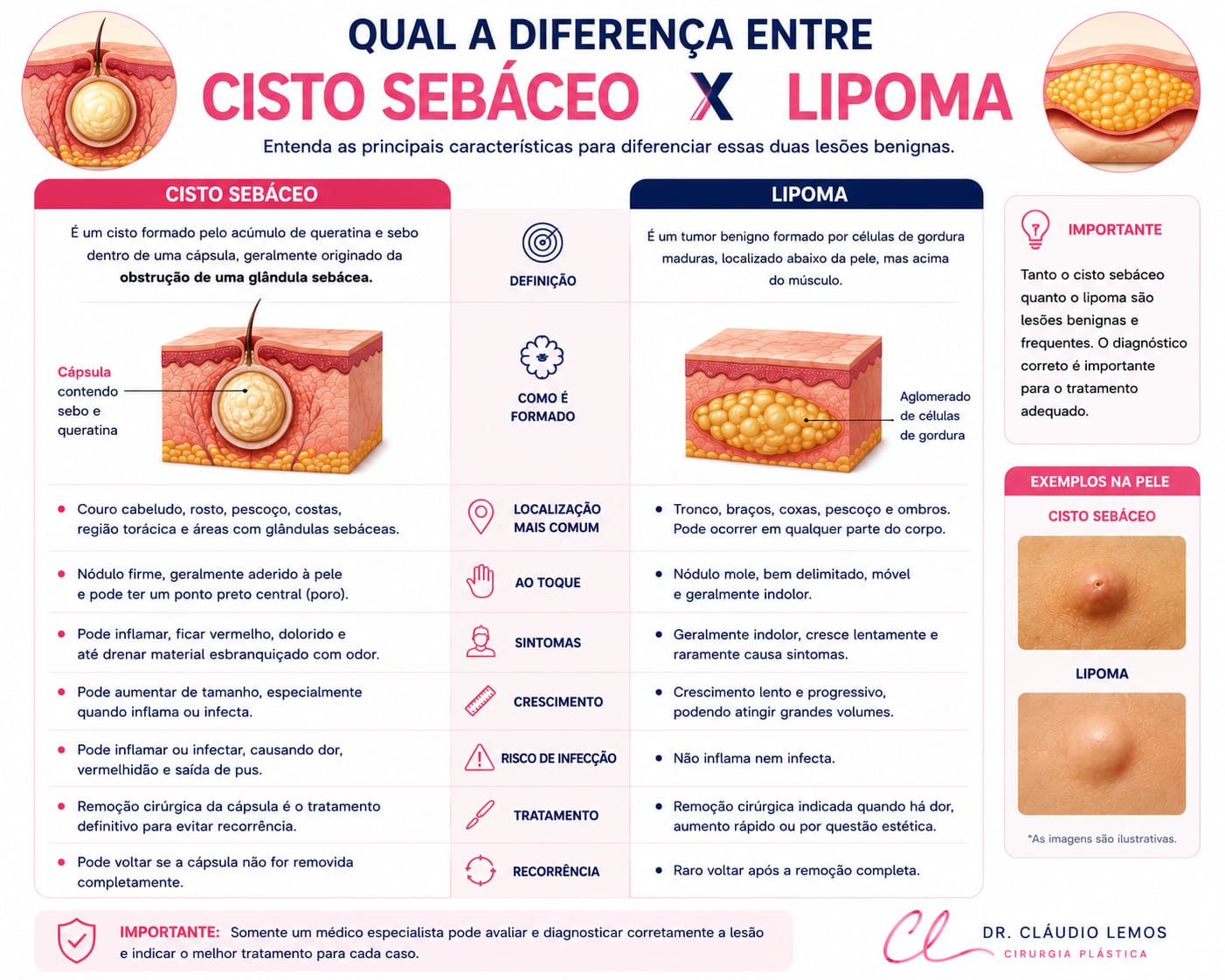 Imagem de Ilustração mostrando a diferença entre Limpoma e cisto sebácio