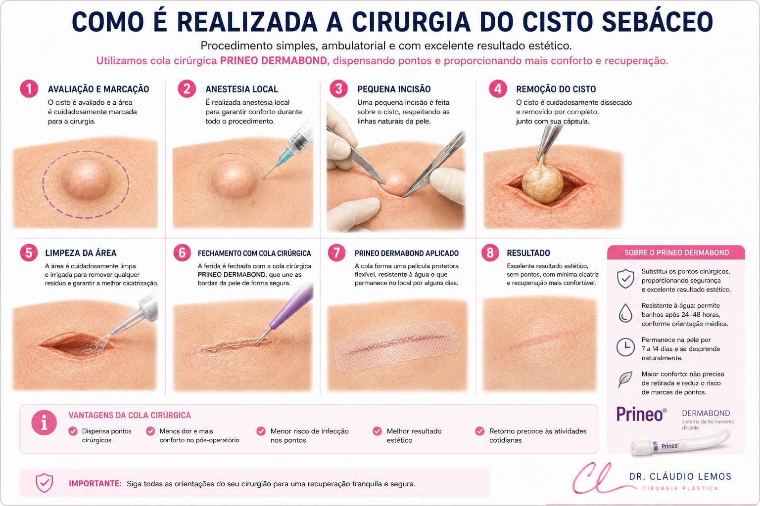 Ilustração de como é feito a cirurgia de remoção do cisto sebáceo