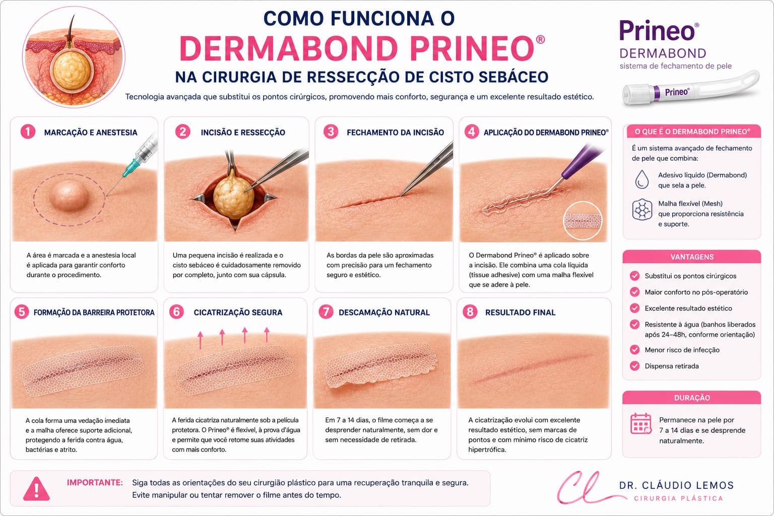 Ilutração de como funcioma o dermabond prineo na cirurgia de ressecção de cisto sebáseo