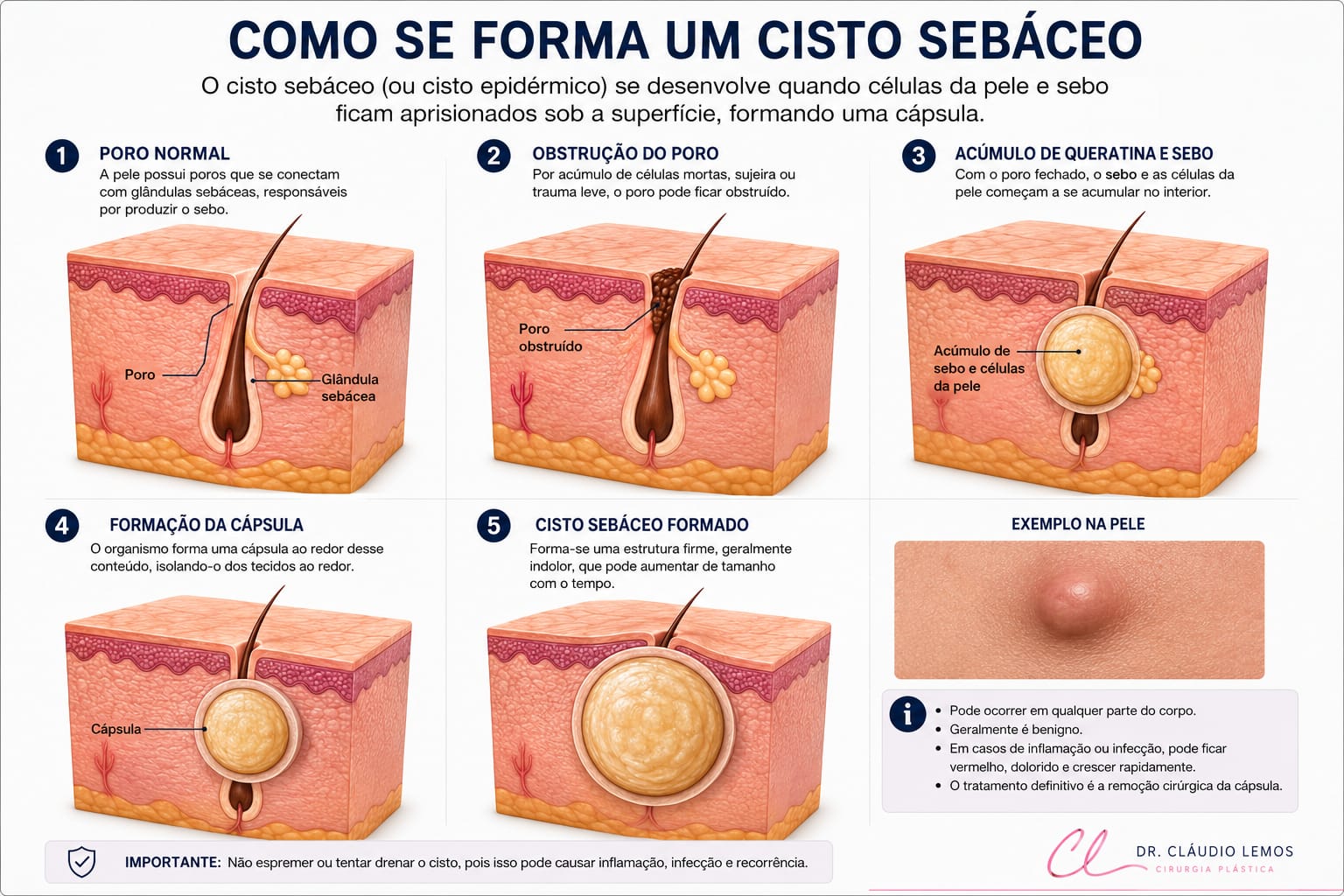 Ilustração de como se forma um cisto sebáceo
