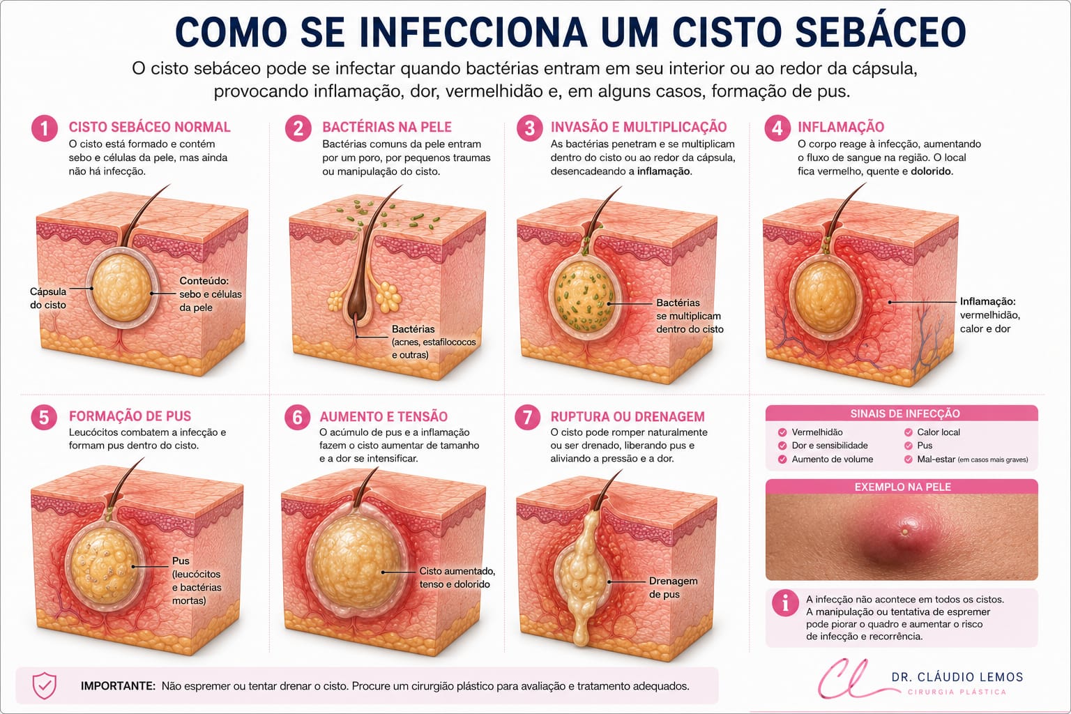 imagem que ilustra como se infecciona um cisto sebáceo
